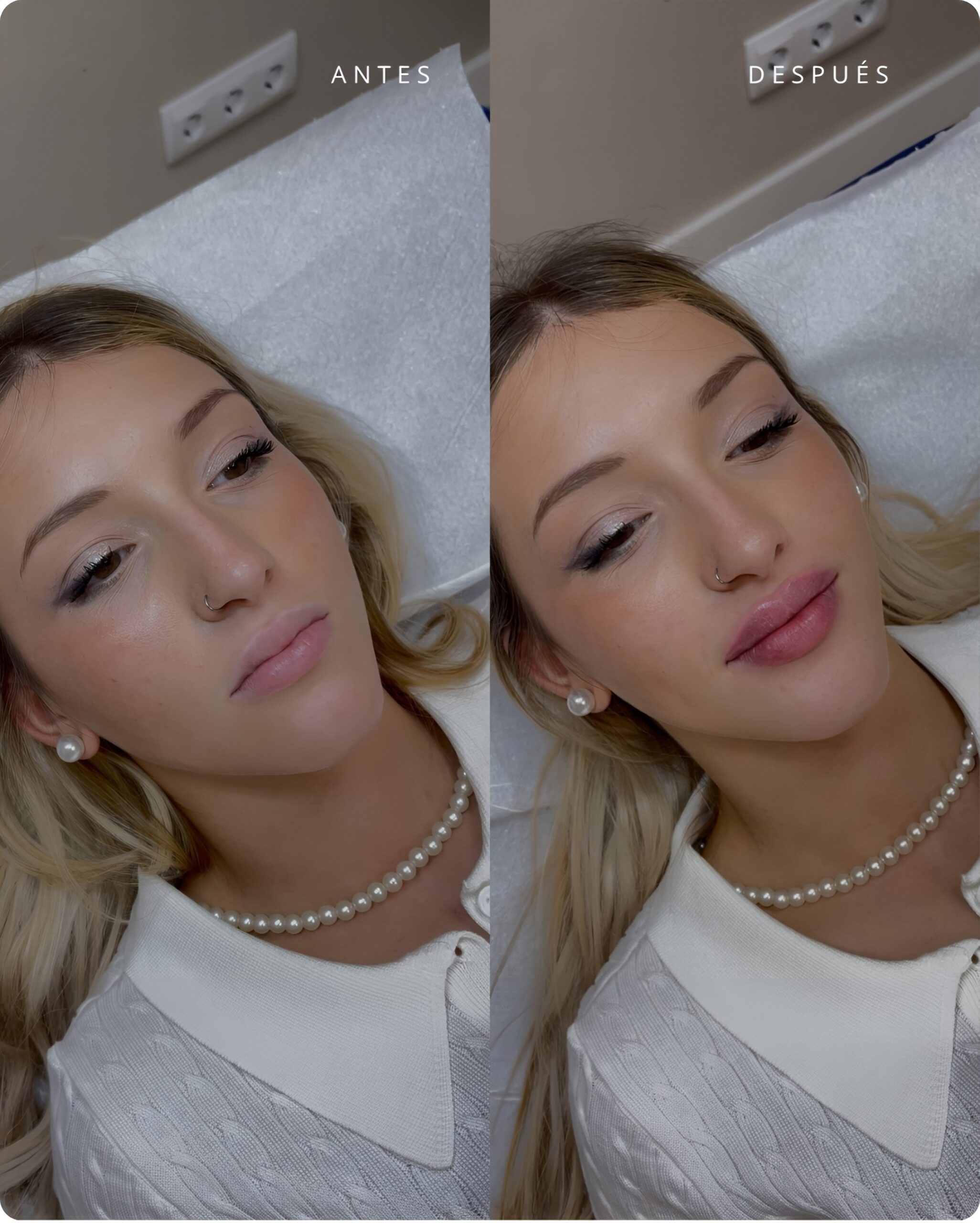 Antes & Después - Hidratación & Definición de Labios - Paciente Real