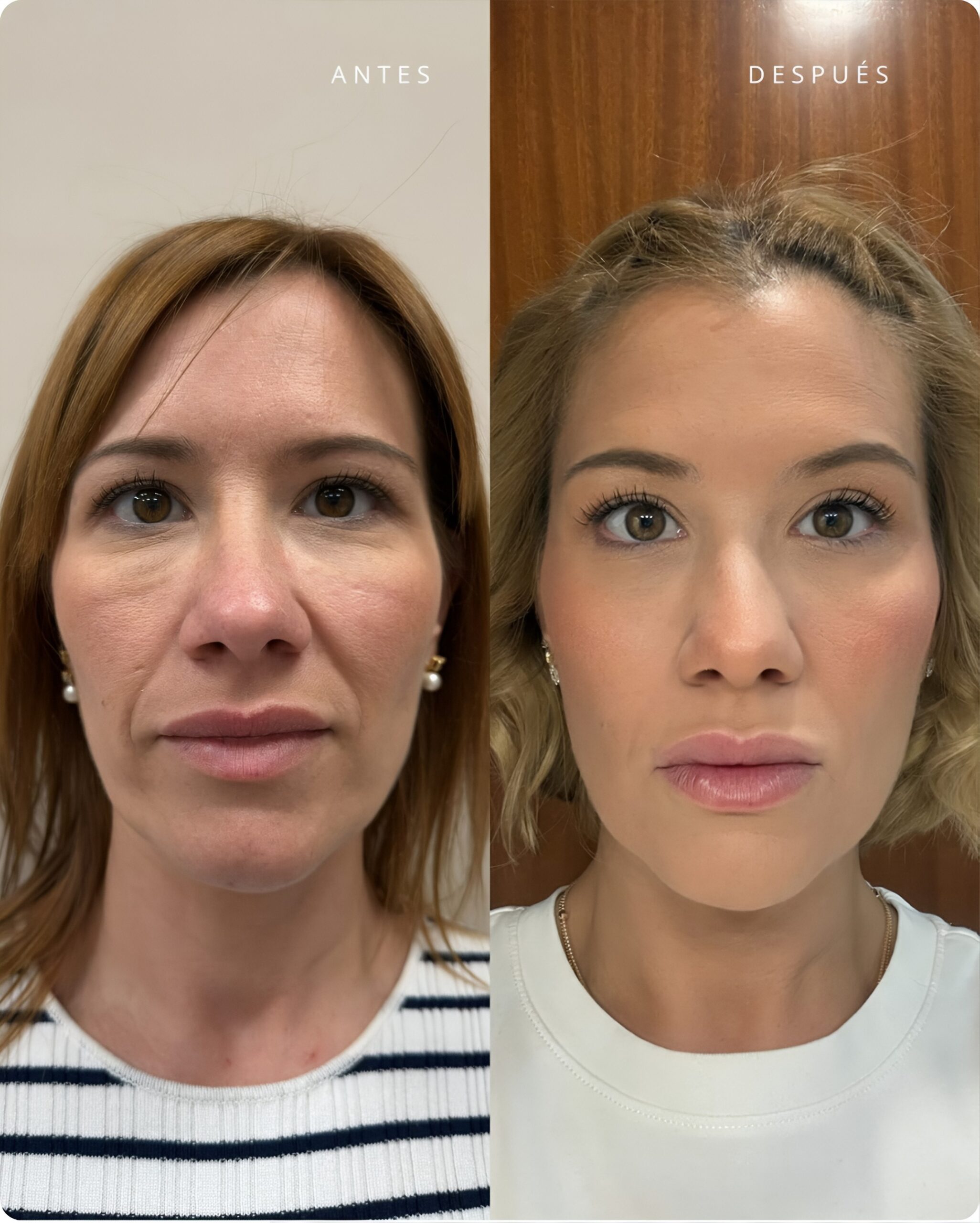 Caso-armonizacionfacial-antes-despues01